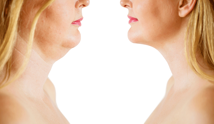 Facial Rejuvenation - Liposuction