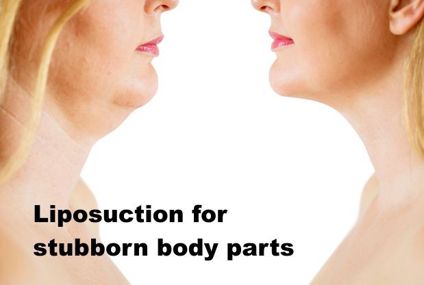 Liposuction for stubborn body parts